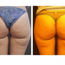 Trattamento Cellulite 2