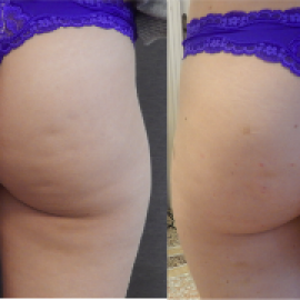 Trattamento Cellulite 1