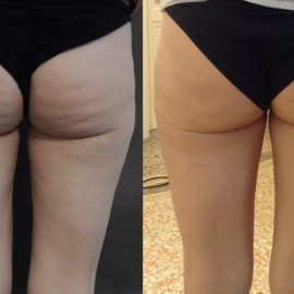 Trattamento Cellulite 4