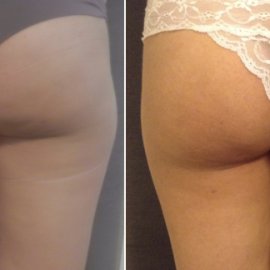 Trattamento Cellulite 5