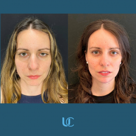Trattamento con filler 1