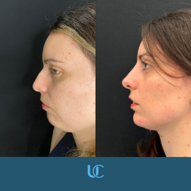 Trattamento con filler 2