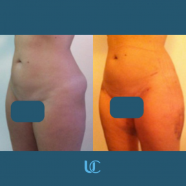 Liposcultura 1