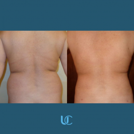 Liposcultura 2