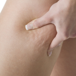 Cellulite grado 20