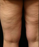 Cellulite grado 30