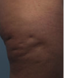 Cellulite grado 40